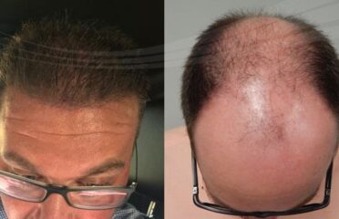 Natural Transplants, Hair Restoration Clinic