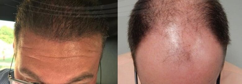 Natural Transplants, Hair Restoration Clinic