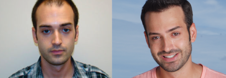 Great Hair Transplants