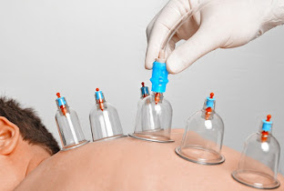 Holistic Hijama Cupping
